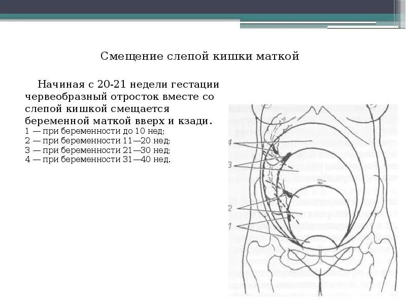 Острый аппендицит у беременных. Аппендицит при беременности 3 триместр. Аппендицит у беременных клинические рекомендации. Аппендицит у беременных в 2 триместре. Острый аппендицит у беременных клинические рекомендации.