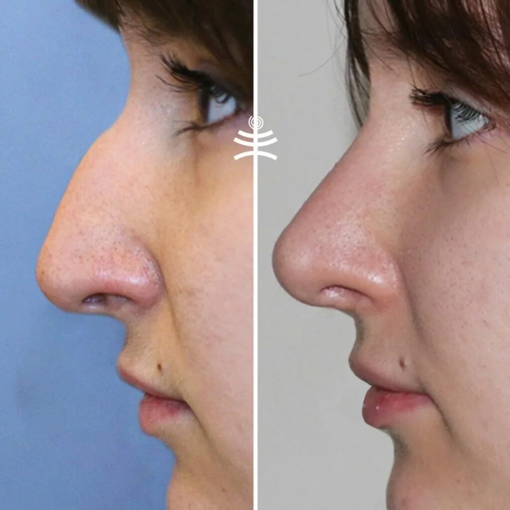 Реконструкция носа. Ринопластика до и после. Уменьшение носа филлерами. Операция по удалению горбинки на носу. Нос после операции отзывы