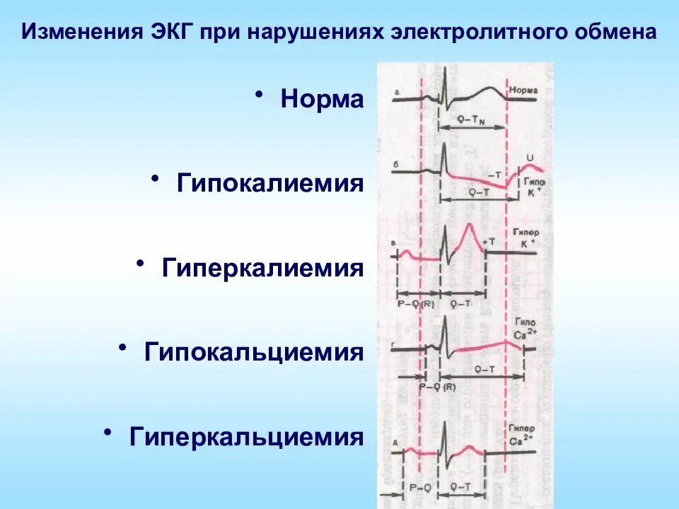Изменения в кардиограмме. Экг при гипокальциемии и гипокалиемии. изменения на экг при гипокальциемии. гипокалиемия и гиперкалиемия на экг. изменения на экг при гипокалиемии.