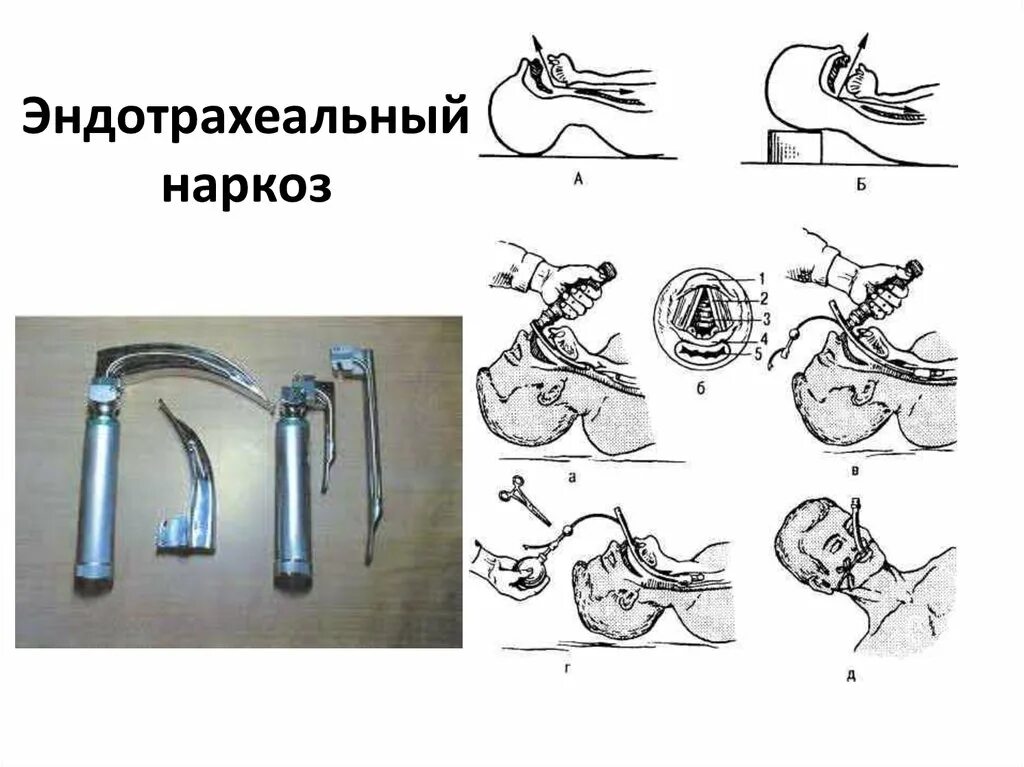 Интубация трахеи наркоз. Эндотрахеальная ингаляционная анестезия. Интубационный эндотрахеальный наркоз. Наркоз трубка интубационная.