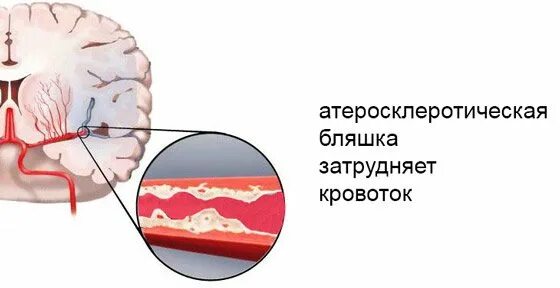 Многоочаговое изменения в головном мозге. Дисциркулярный характер головного мозга. Дисциркуляторные очаговые изменения головного мозга. Очаговые изменения вещества головного мозга. Что означает очаговое изменение мозга