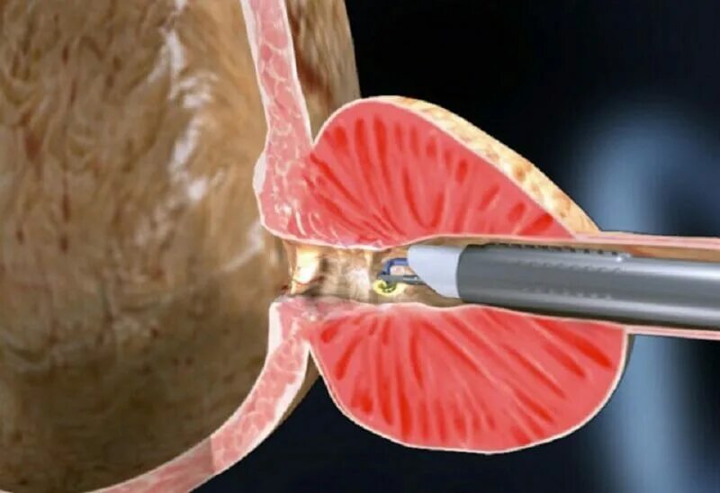 Подозрения на простату. Трансуретральная инцизия. Трансуретральная резекция. Трансуретральная инцизия простаты (ТУИП). Тур трансуретральная резекция простаты.