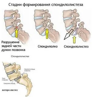 Антилистез