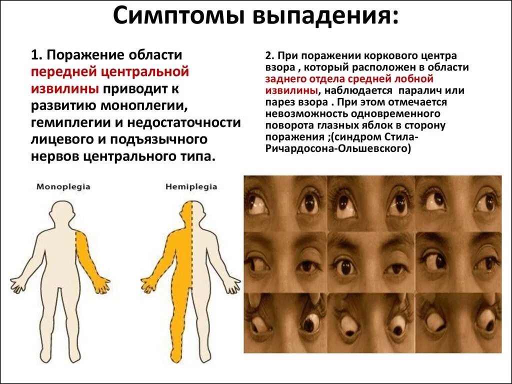 Поражение это простыми словами. Симптомы поражения центральных извилин. Симптомы выпадения неврология.