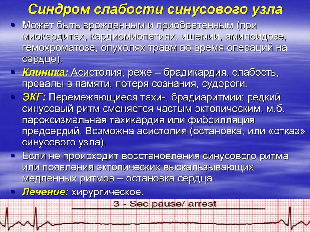 Дисфункция синусового узла что это. Синдром слабости синусового ЭКГ. Синдром слабости синусового узла на ЭКГ. Синдром слабости синусового узла ЭКГ критерии. Синусовая брадикардия на ЭКГ.