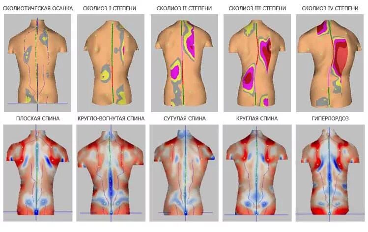 Схема боли в спине. Тейпирование сколиоза. Мышцы при сколиозе. Мышцы спины при сколиозе. Напряженные мышцы при сколиозе.