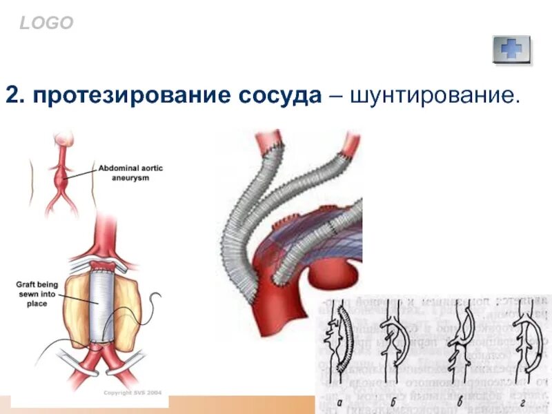 Операция шунтирование нижних. Шунтирование сосудов нижних конечностей. Протезирование артерий.