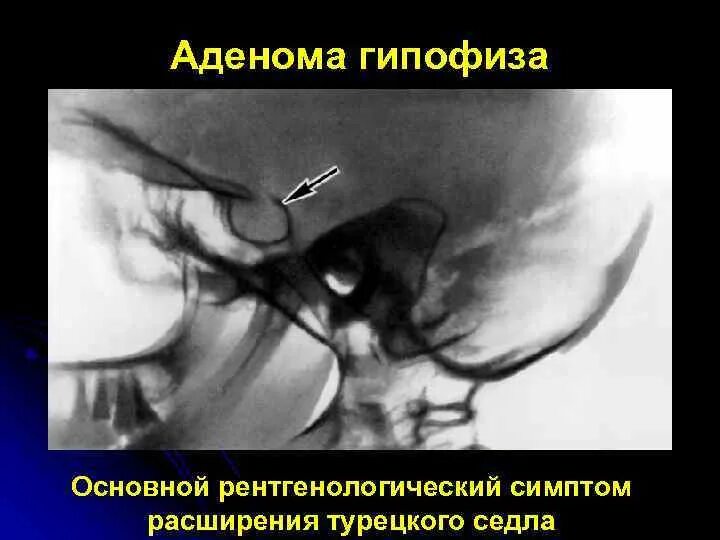 Симптом турецкого седла. Рентген турецкого седла опухоль гипофиза. Аденома турецкого седла на рентгене. Опухоль турецкого седла рентген. Снимок турецкого седла рентген.