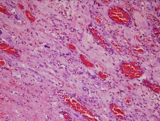 менинготелиоматозная менингиома гистология. мультиформная глиобластома патоморфология. менинготелиоматозная менингиома гистология. гистология опухоли мозга. астроцитома головного мозга гистология.