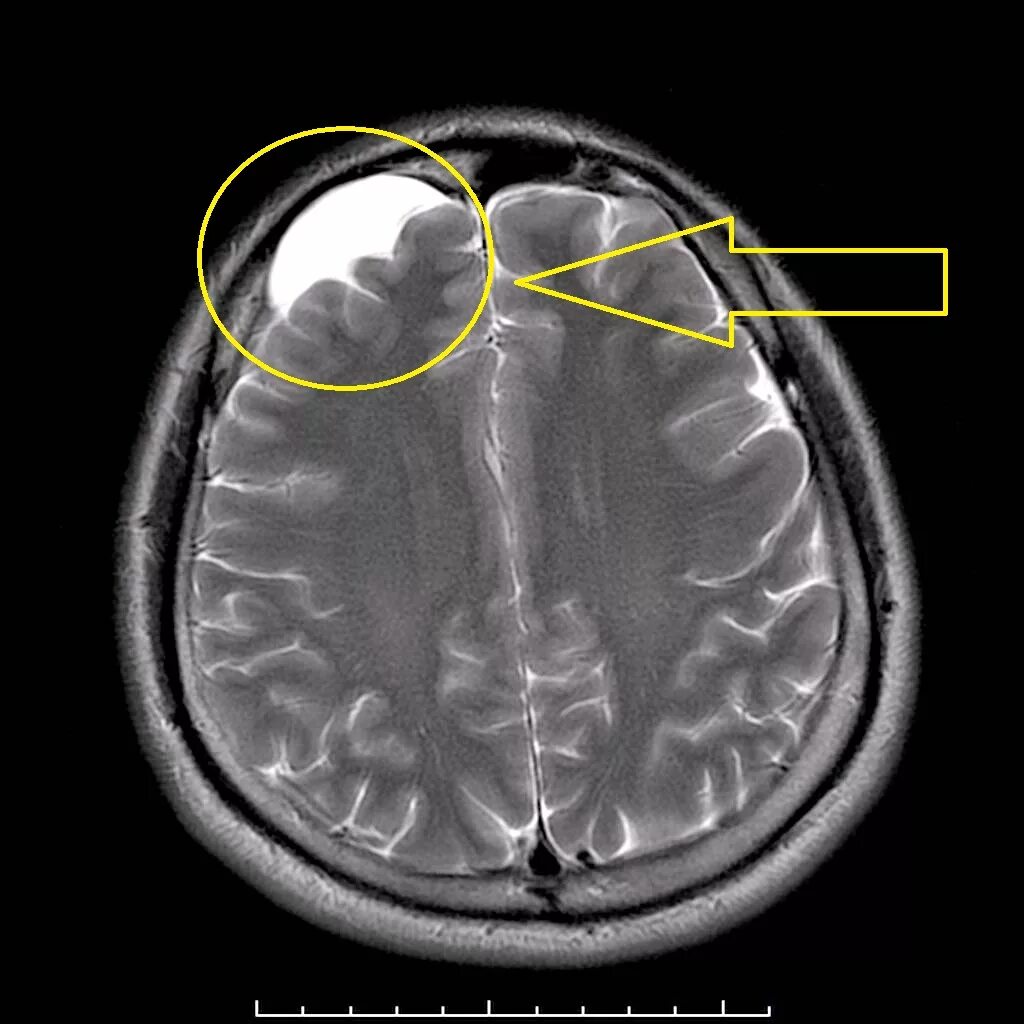 Чем опасна киста в мозгу. Арахноидальная киста лобной области мрт. Ретроцеребеллярная арахноидальная киста в головном мозге мрт. Арахноидальная киста головного мозга мрт. Ликворная киста головного мозга мрт.