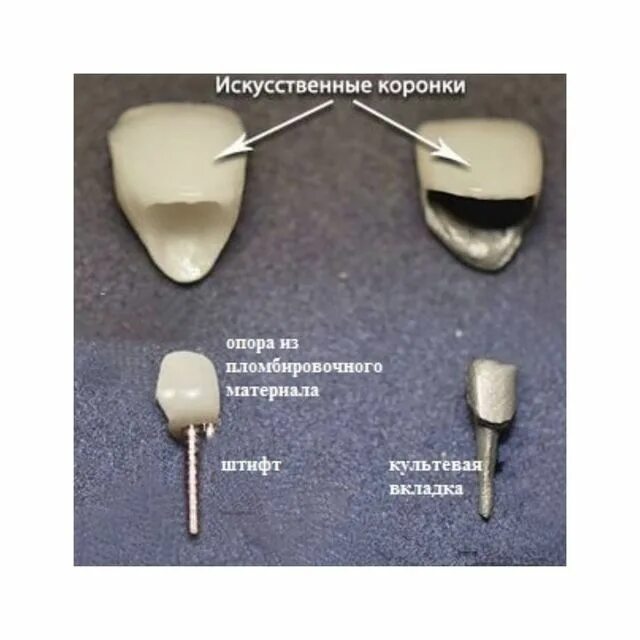 стекловолоконный штифт билдап. стекловолоконный штифт культя зуба. свш стекловолоконный штифт. матчпост стекловолоконный штифт. Build up стекловолоконный штифт.