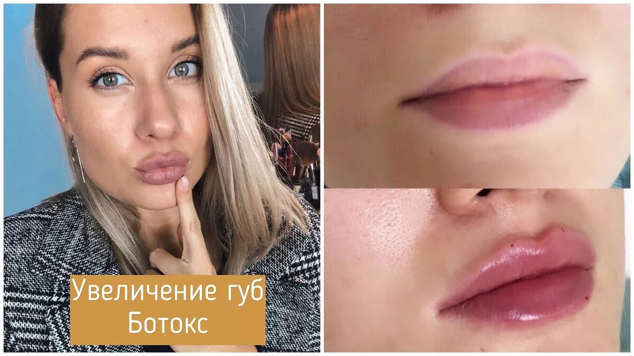 Увеличение губ стоматолог. Накаченные губы до и после.