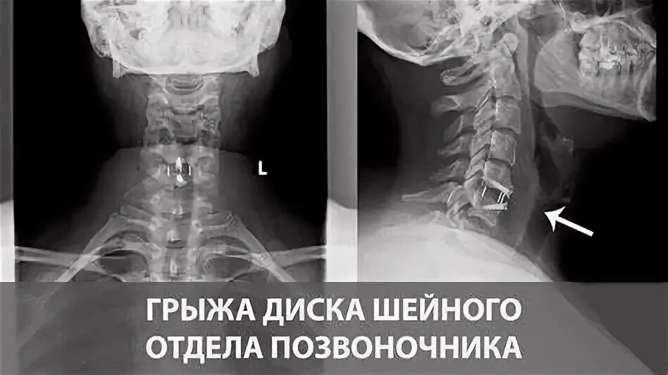 Грыжа в шейном отделе симптомы. Грыжа в шейном отделе симптомы