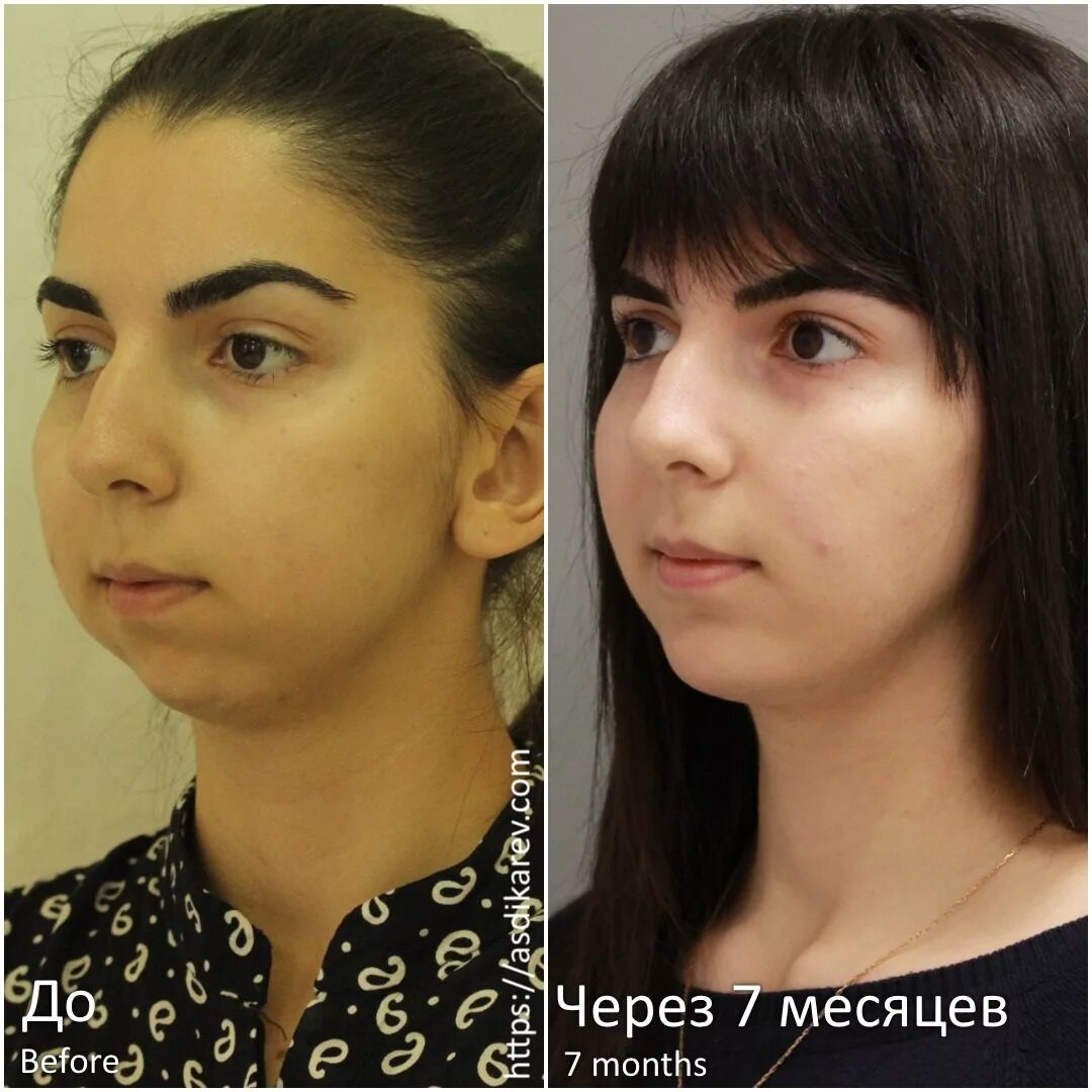 Картинки ЗАЧЕМ УДАЛЯЮТ КОМКИ БИША