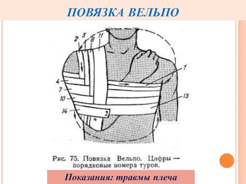 Перевязка Вельпо. Повязка Дезо и Вельпо. Вельпо повязка на плечевой сустав алгоритм. Повязка Вельпо техника наложения.