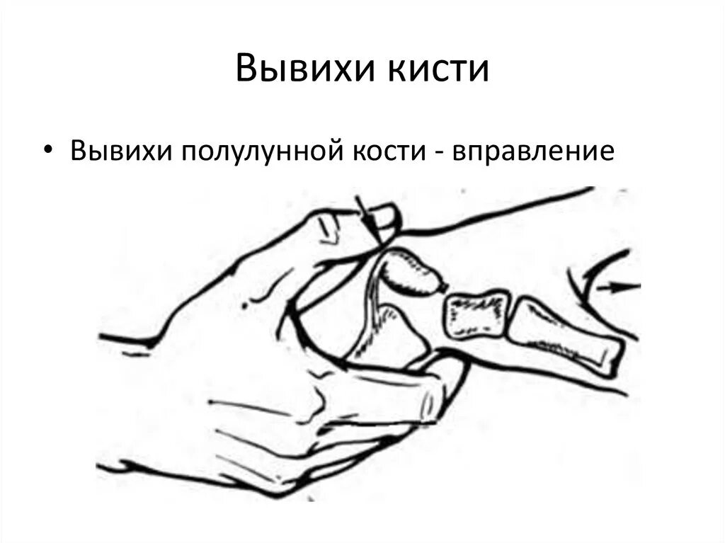 Как выглядит вывих запястья руки Болезнь Кинбека причины, симптомы и лечение в Москве