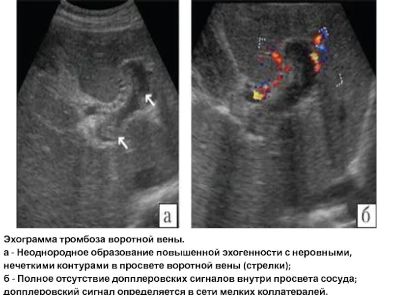 Эхогенность селезенки. Тромбоз селезеночной вены на УЗИ. Тромбоз воротной вены на УЗИ. Тромбоз портальной вены УЗИ. Тромб в воротной Вене на УЗИ.