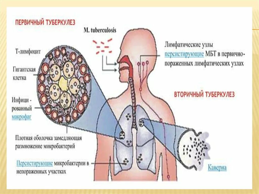 Внутренний туберкулез