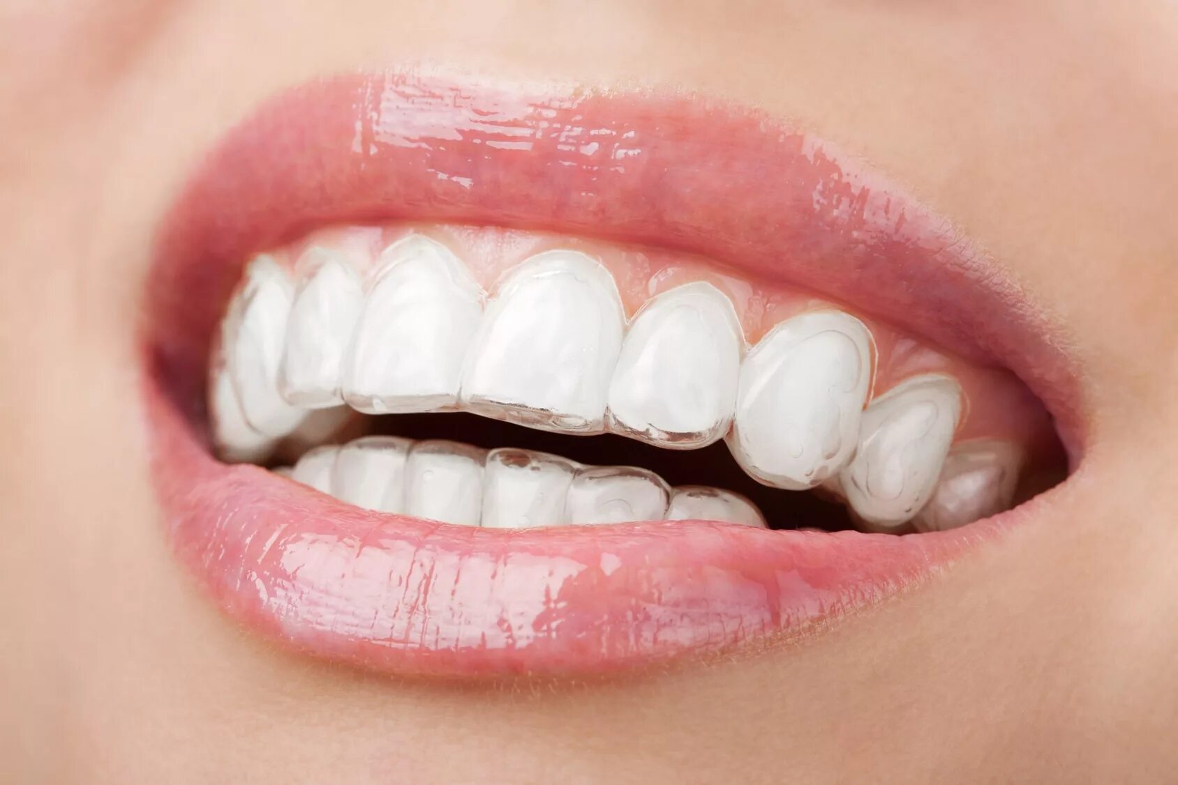 Элайнеры это. Элайнеры invisalign. каппы инвизилайн. капа инвизилайн ортодонтическая инвизилайн.