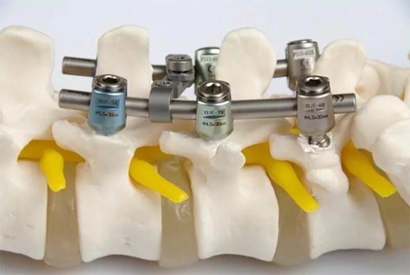 Операция фиксация позвоночника. Операция транспедикулярная фиксация позвоночника. Транспедикулярная система Зиммер. Транспедикулярная фиксация l3 l4. Транспедикулярная фиксация 。 Th11-l1..