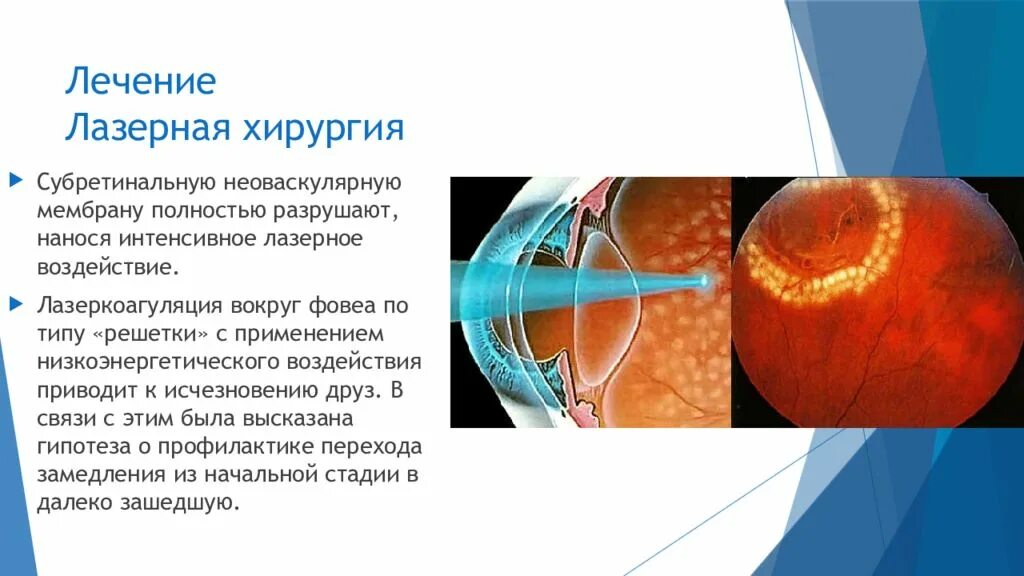 Макула и задний полюс