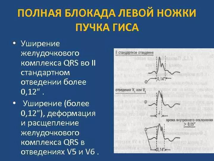 Левая ножка п гиса. Блокада ЛНПГ на ЭКГ. Полная блокада левой ножки пучка Гиса. ЭКГ критерии блокады левой ножки пучка Гиса. Блокада левой ножки пучка Гиса на ЭКГ.