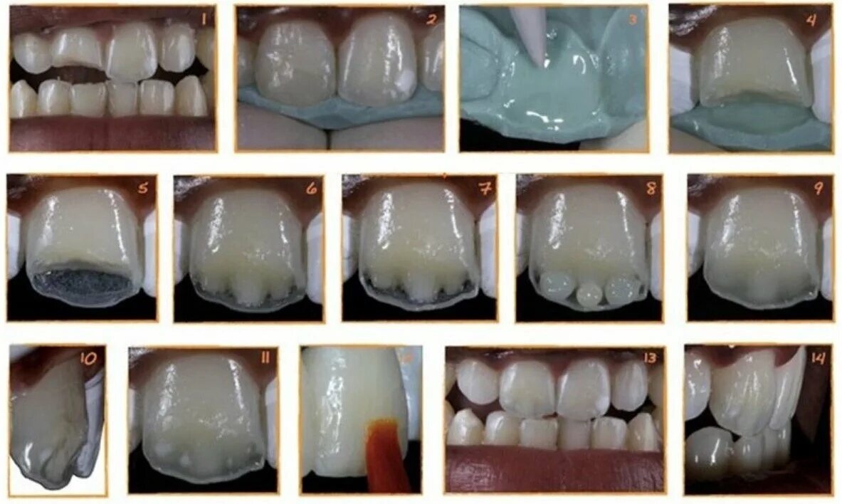 Микропротезы виниры вкладки стоматология. Зубы клиновидный кариес. Восстановление передних зубов. Реставрация фотополимером