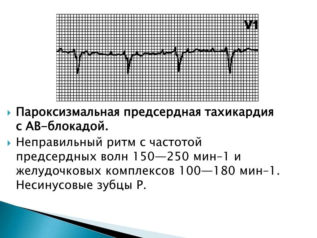 Предсердная блокада. Предсердная тахикардия с АВ блокадой 2 степени на ЭКГ. Предсердная тахикардия с АВ блокадой 2:1. Предсердная пароксизмальная тахикардия на ЭКГ. Предсердная тахикардия с АВ проведением 2 1.