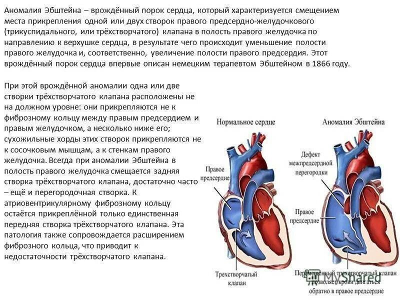 Недостаточность предсердия. Аномалия Эбштейна гемодинамика. Аномалия Эбштейна сердца клинические рекомендации. Врождённый порок сердца трикуспидальный клапан. Врожденный порок сердца Эпштейна.