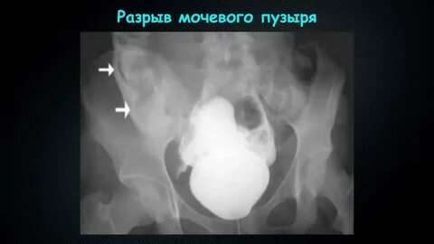 Гематома мочевого пузыря