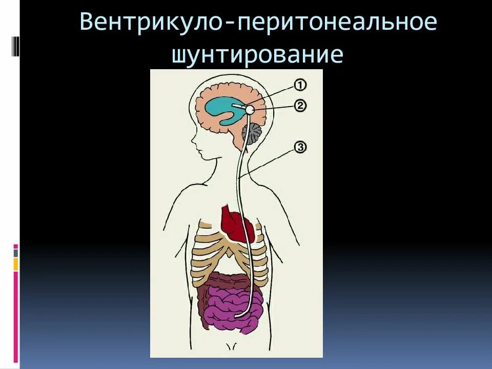 Вентрикуло-перитонеальное шунт. Вентрикулоперитонеальный шунт схема. Операция вентрикулоперитонеальное шунтирование. Вентрикуло-перитонеальное шунтирование головного мозга.