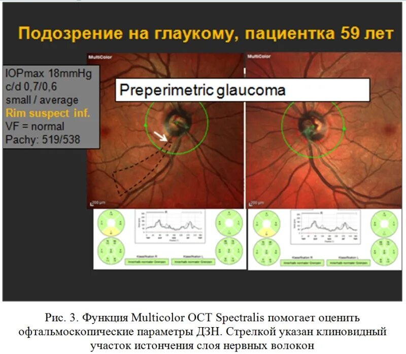Зрительный нерв при глаукоме. Томография зрительного нерва глаукома. Оптическая когерентная томография ДЗН. Оптическая когерентная томография диска зрительного нерва. Окт зрительного нерва при глаукоме.
