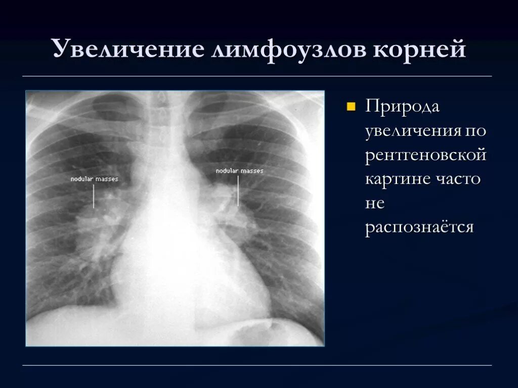 Увеличение корень легкого. Лимфоузлы на рентгене легких. Лимфатические узлы на рентгене легких. Увеличенные лимфоузлы на рентгене. Увеличенные лимфоузлы в легких на рентгене.