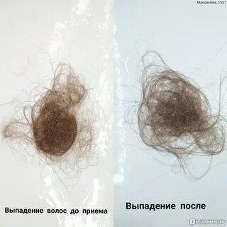 Выпадают волосы анализы