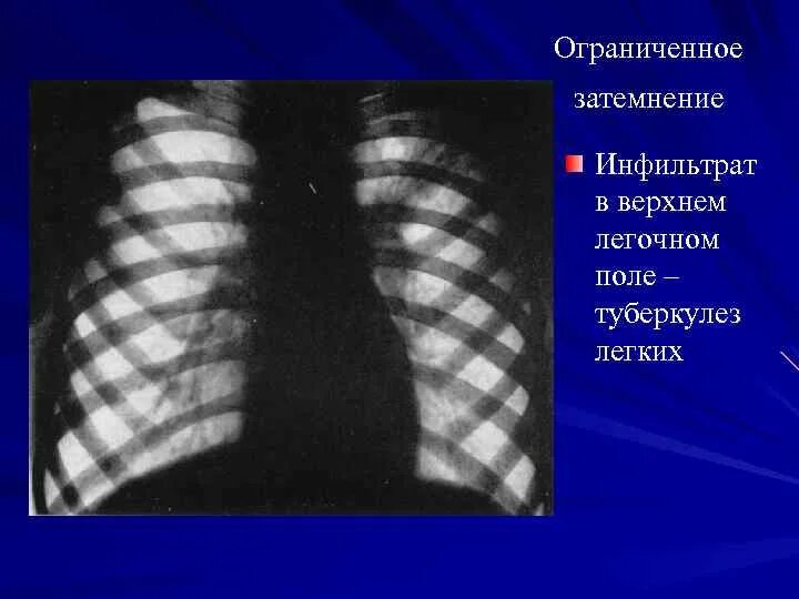 Затемнение легкого диагноз. Рентген тотальное затемнение легкого. Округлое образование в легких. Субтотальное затемнение легких рентген. Сегментарный ателектаз s4.