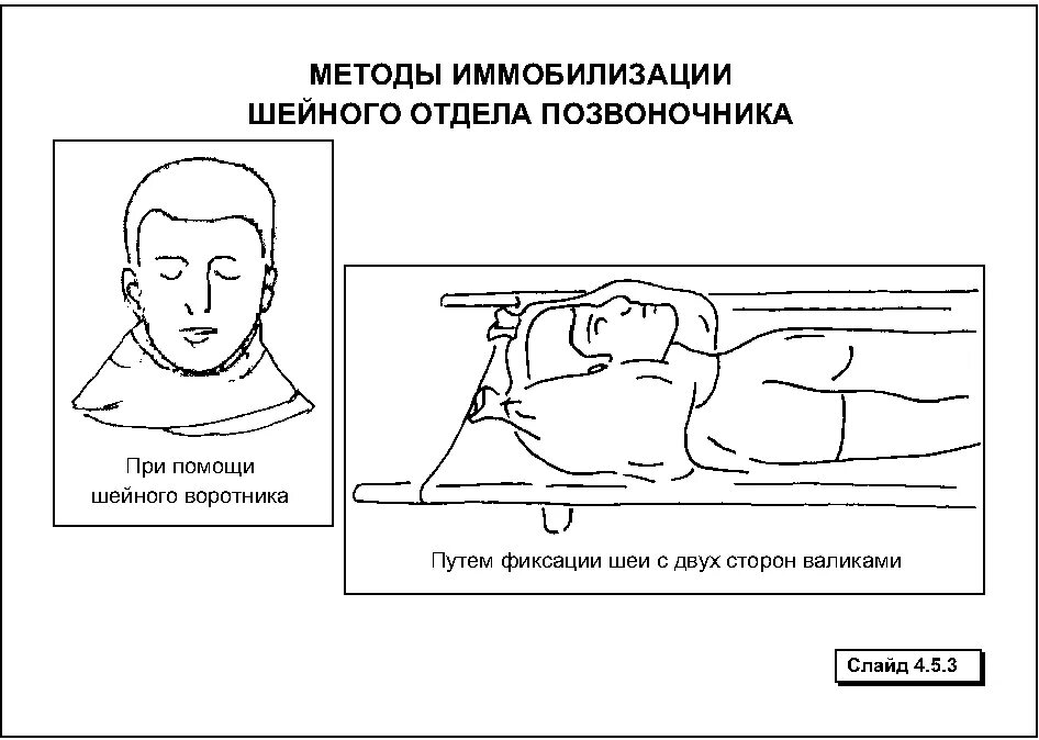 Шина при травме головы. Иммобилизация при повреждении шейного отдела позвоночника. Закрытый перелом шейного отдела позвоночника первая помощь. Перелом шейного отдела позвоночника иммобилизация. Иммобилизация шейного отдела позвоночника алгоритм.