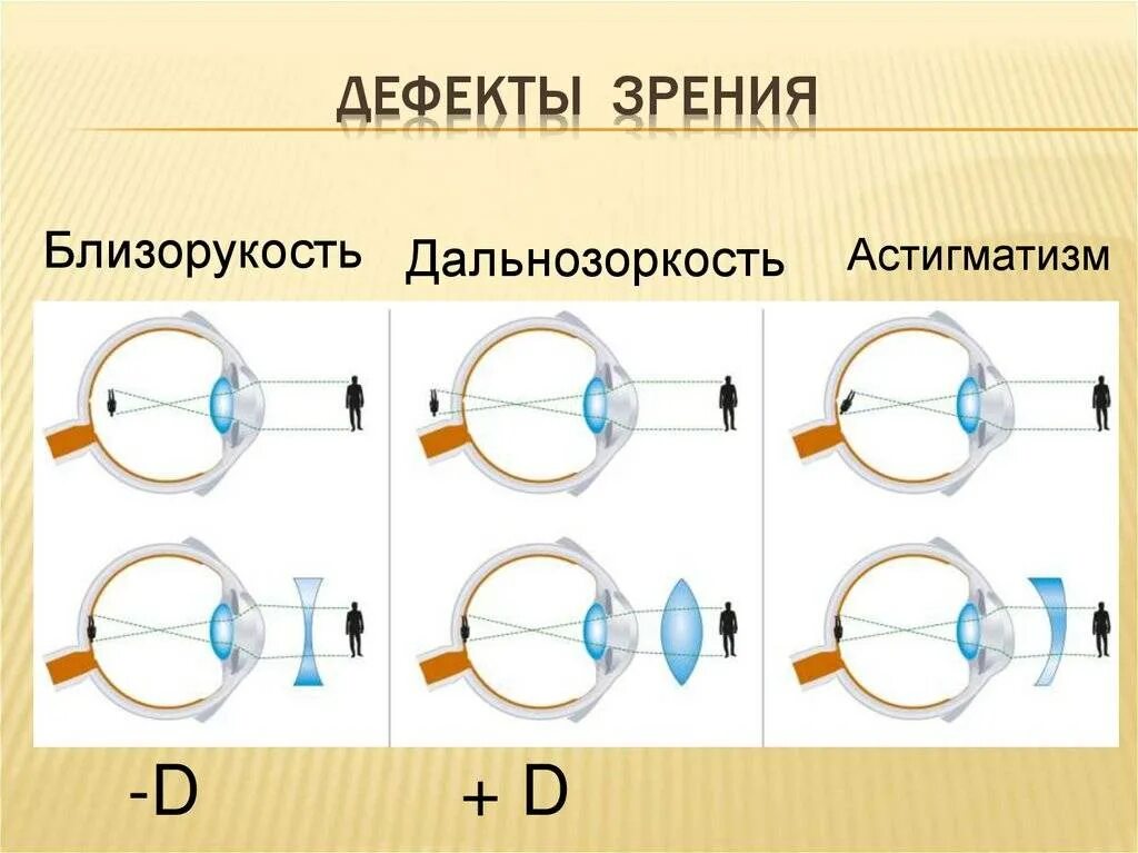 Зрение 3 какие линзы. Дефекты зрения. изображение линзы предметнаискосок.