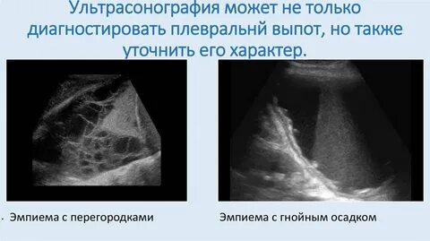 Узи плевральной