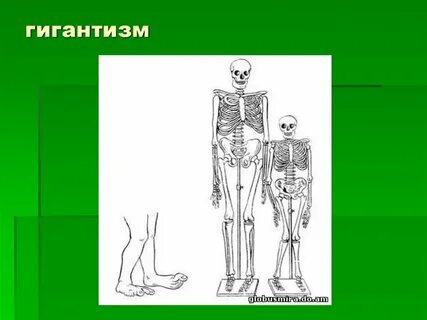 Гигантизм