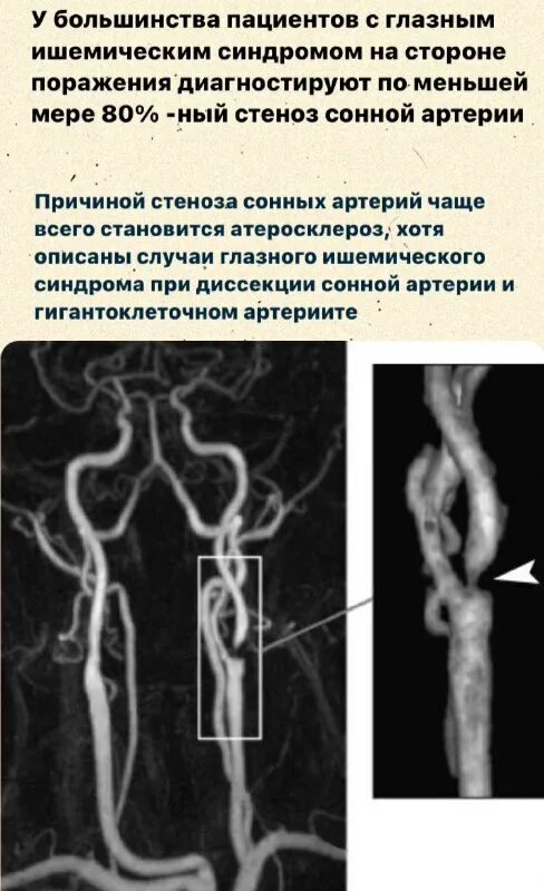 Атеросклероз позвоночных артерий. Диссекция позвоночной артерии на кт. Гипоплазия v4 сегмента правой позвоночной артерии. Мрт ангиография сосудов шеи. Атеросклероз церебральных артерий симптомы.
