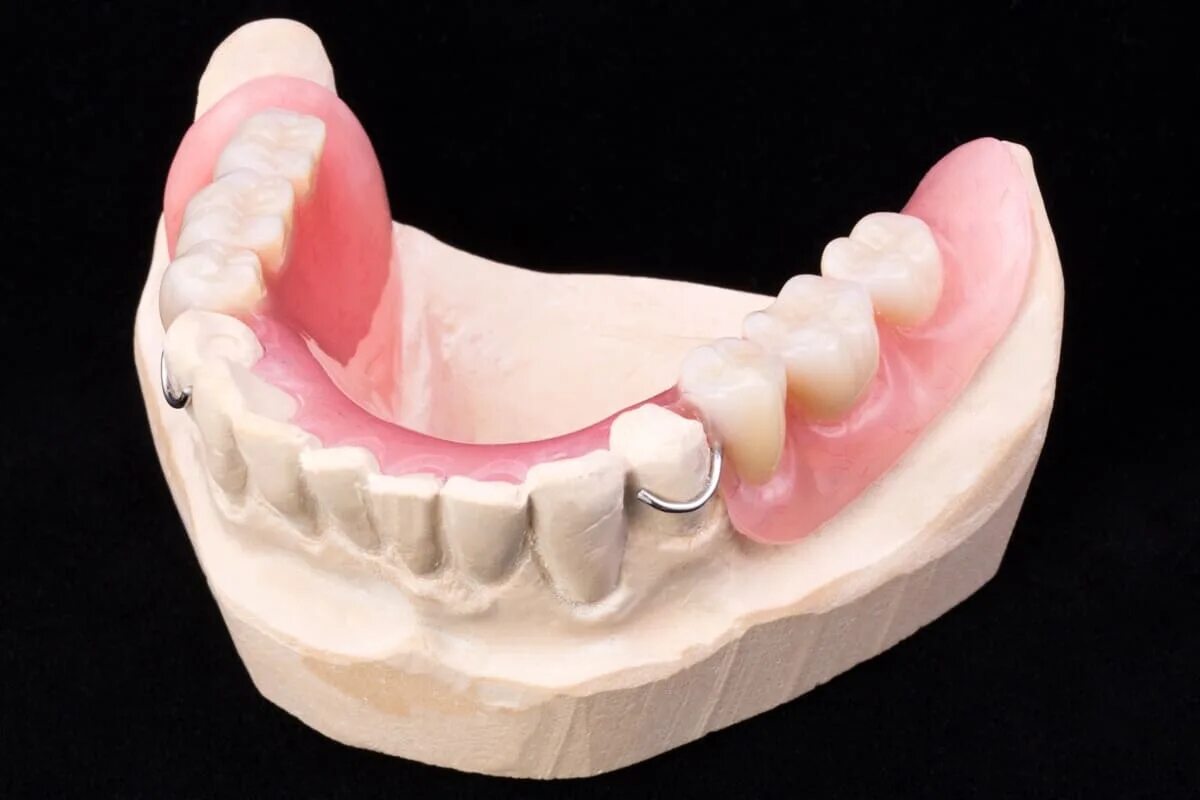 Протезист спб. Съемный протез (3-5 зубов) термо Джет. Полносъемные протезы ортопедическая стоматология. Нейлоновый бюгельный протез.