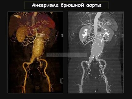 Аневризма брюшной аорты что это такое