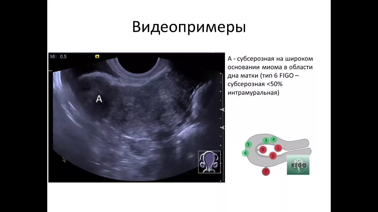 Классификация Figo миома матки на УЗИ. Субсерозная миома матки Figo 6. Миома матки классификация Figo. Figo 3 миома матки. Миома мкб 10 у взрослых