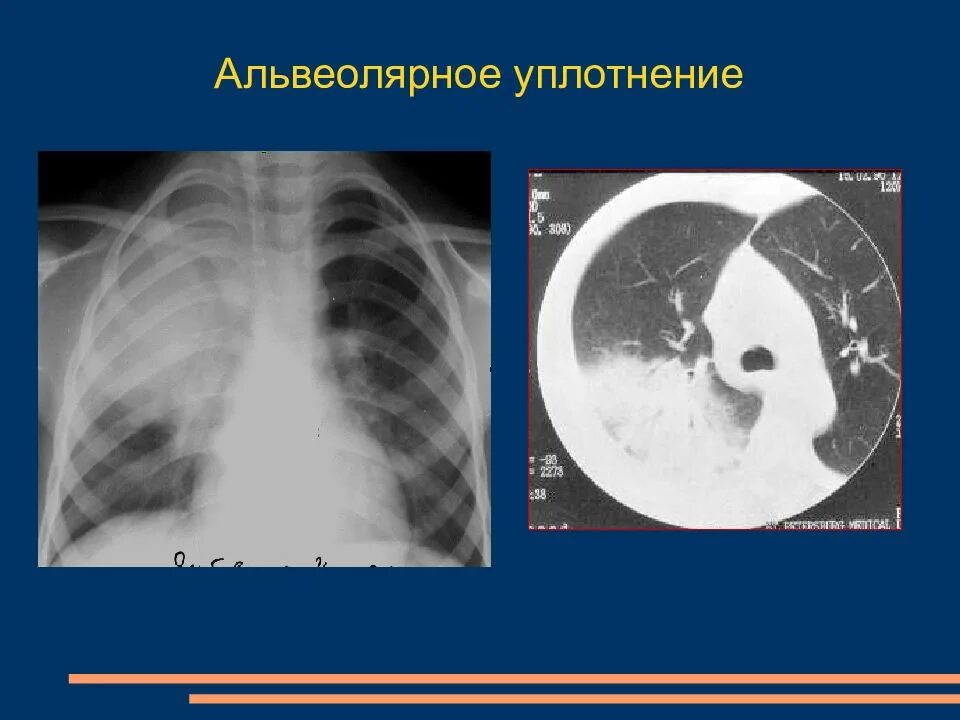 Уплотнение легких что это такое. Уплотнение легочной ткани на кт. альвеолярное уплотнение. уплотнение в снимке легких. уплотнения в легком кт.