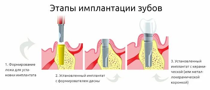 Костная ложа