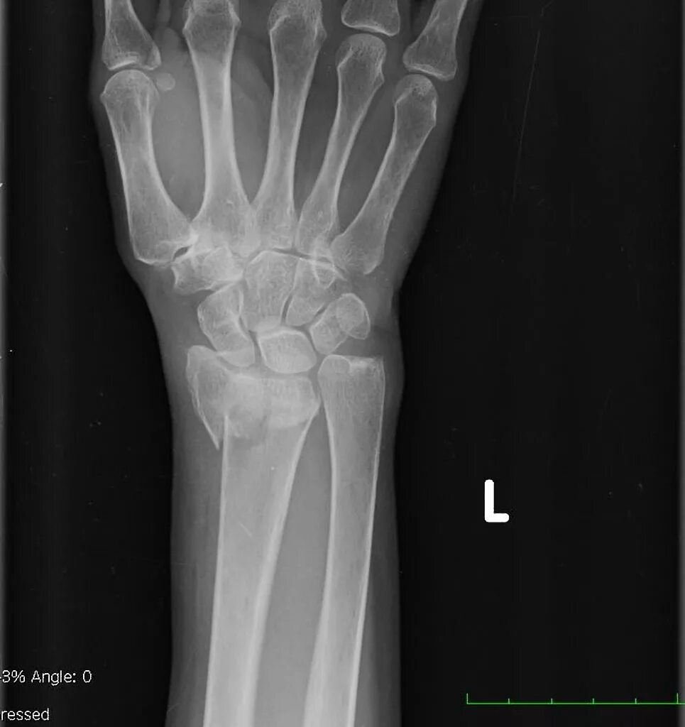 Смещение кости на руке без перелома. Рентген кисти руки с переломом лучевой кости. Перелом лучезапястного сустава рентген. Внутрисуставной перелом лучевой кости. Перелом лучевой кости рентген.