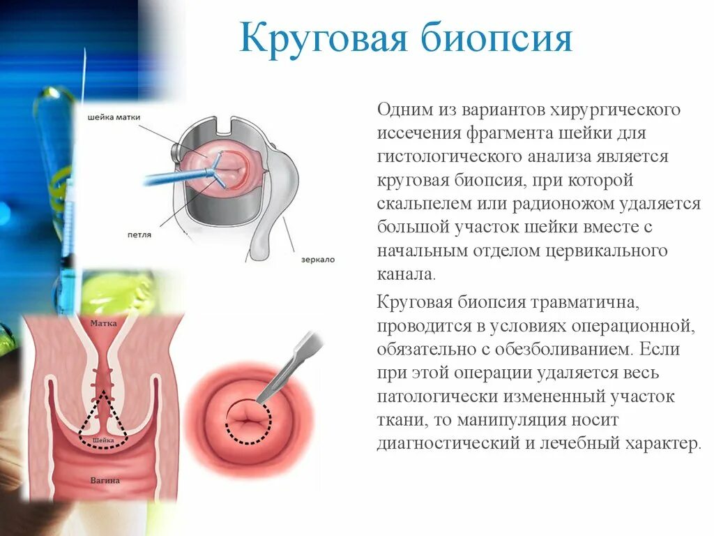 Ножевая биопсия. Петлевая эксцизия шейки. Эксцизионная биопсия шейки матки петлевая. Радиоволновая петлевая биопсия шейки матки. Эксцизионная биопсия шейки матки показания.