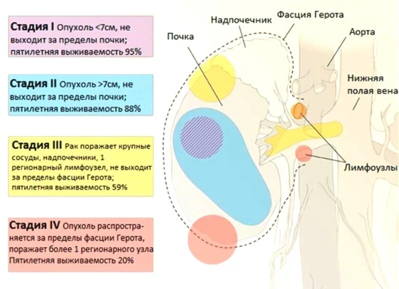 Лимфоузлы надпочечников. Новообразование 4 степени почки. Опухолевые заболевания почек. Новообразование 1 степени почки. Опухоль почки стадии т1а.