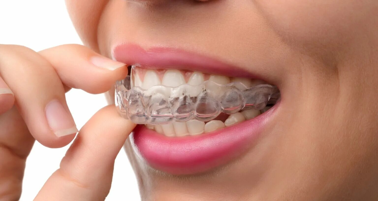 Элайнеры на зубах фото. Каппы инвизилайн. Каппы инвизилайн invisalign. Каппа на отсутствующий зуб. Элайнеры invisalign.