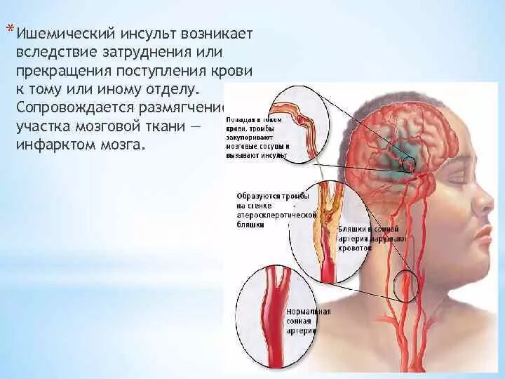 Ишемический инсульт головного мозга. Ишемическом мозговом инсульте.